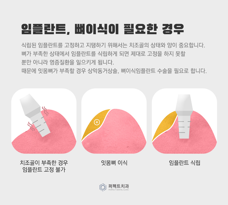 컴퓨터 분석을 통한 임플란트 관련 이미지 9