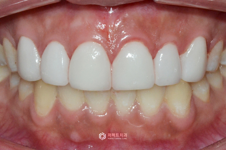 6년 전 라미네이트 교체&연장, 그 이유는?😯 관련 이미지 4