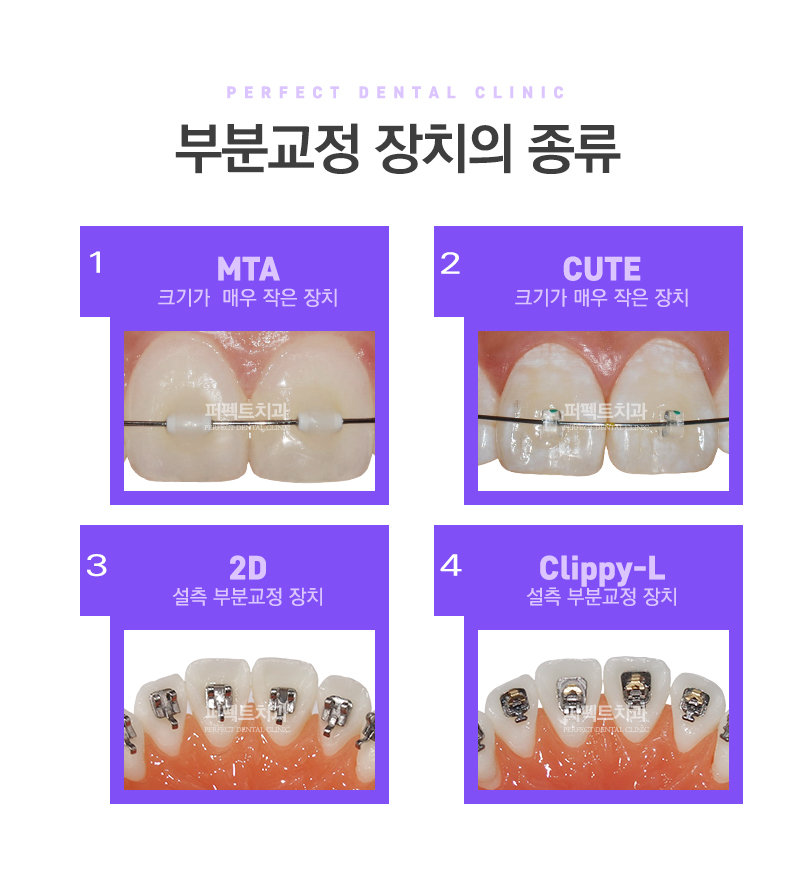 성인 앞니부분교정 관련 이미지 3
