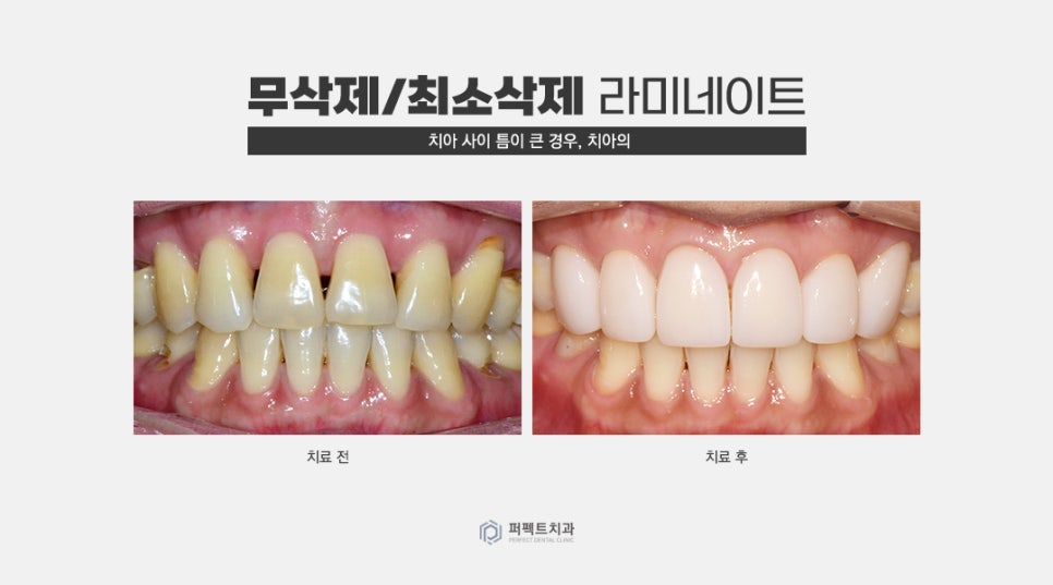 무삭제 라미네이트 추천 및 가능한 케이스 확인하기 관련 이미지 3