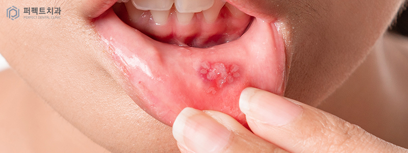 유아 구내염 원인 및 예방법 관련 이미지 2
