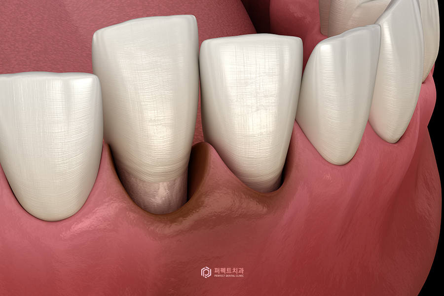 치아가 시린 다양한 이유! 관련 이미지 4