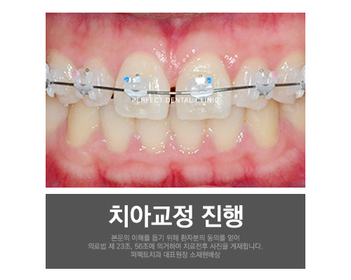 치아교정 후 치아모양이 마음에 들지않으면? 관련 이미지 3