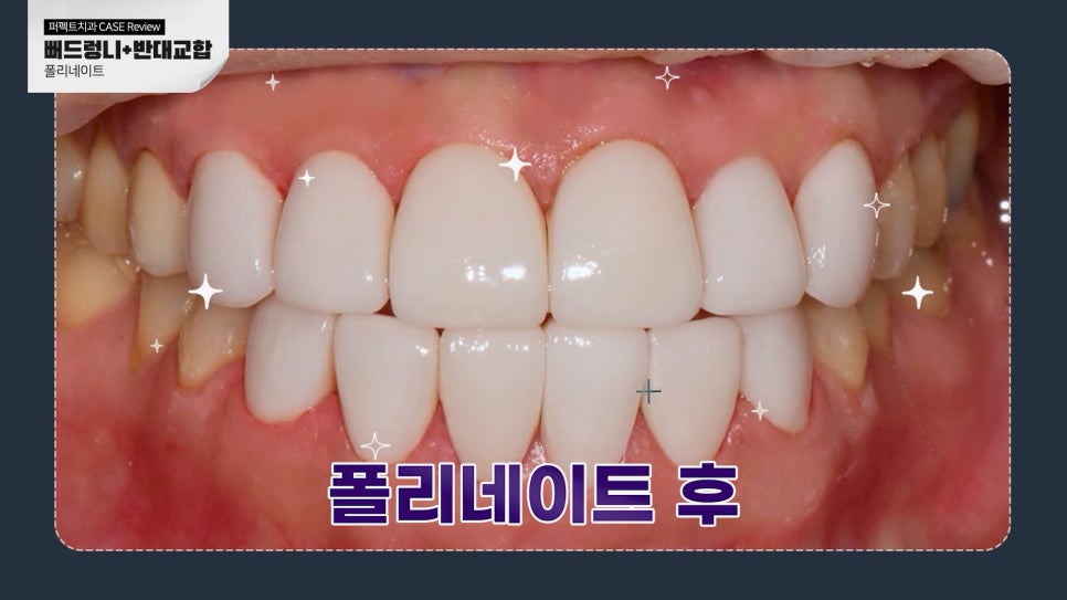 앞니 폴리네이트+치아미백 치료 관련 이미지 7