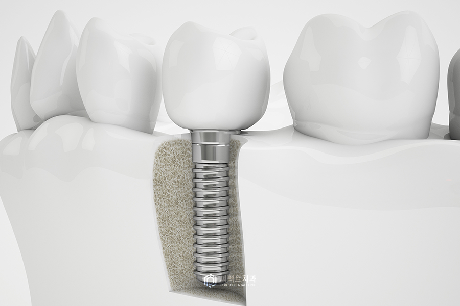 임플란트 한 번 심으면 평생 쓸 수 있나요?(2) 관련 이미지 2