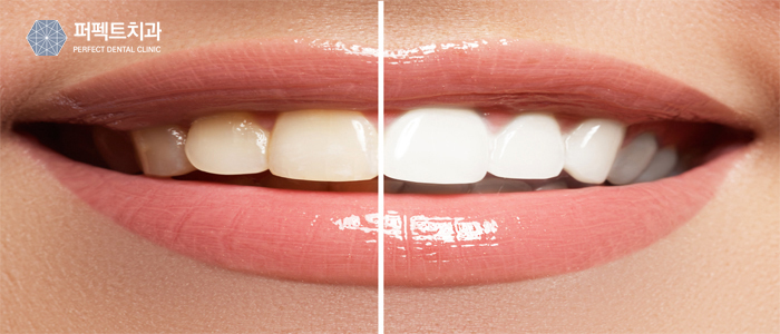 라미네이트와 치아성형 큰 차이점 관련 이미지 2