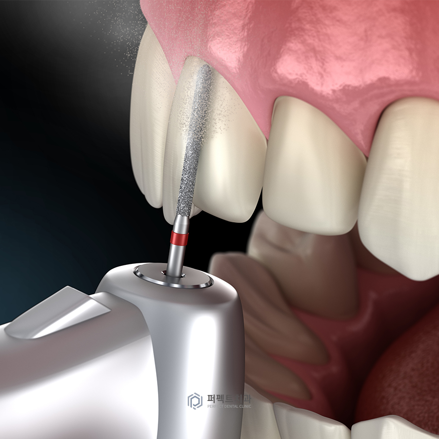 라미네이트 후 교정 유지장치는? 관련 이미지 3
