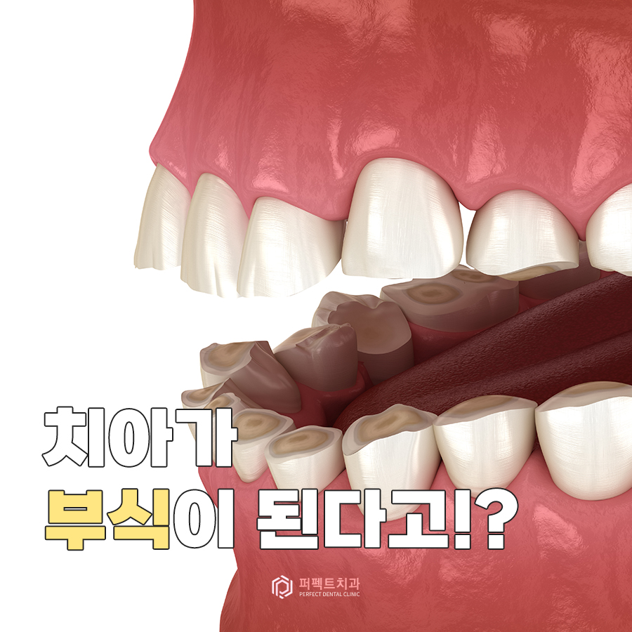 치아도 부식이 된다? 부식의 원인과 치료방법! 관련 이미지 1