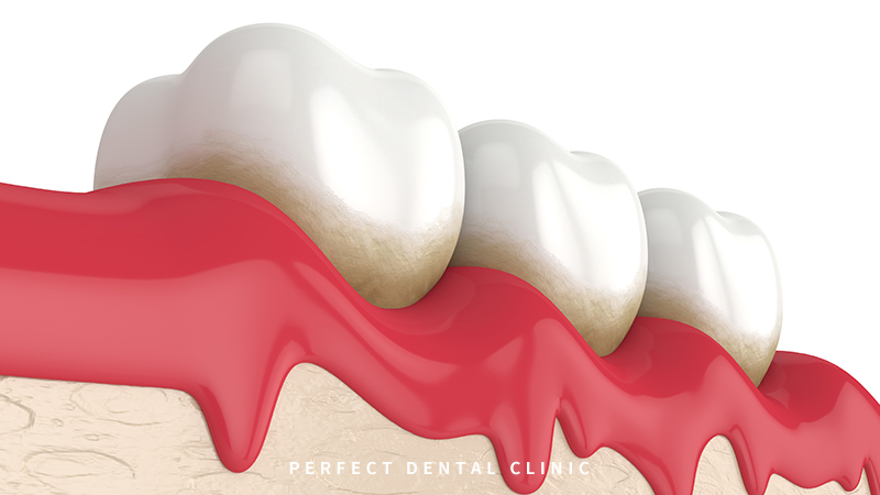 치주염, 치은염 치료와 예방법 관련 이미지 1