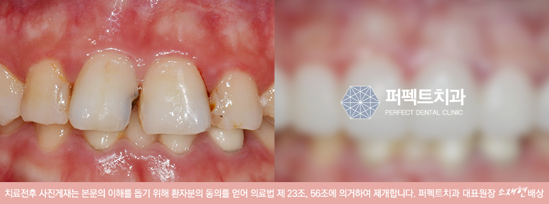 나에게 라미네이트 부작용이 생긴 이유 관련 이미지 2