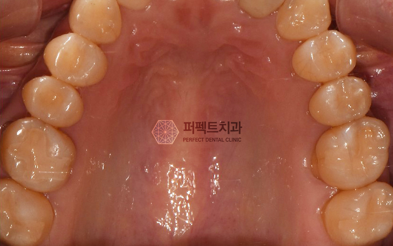 앞니 충치 레진 비용 알아보기! 관련 이미지 3