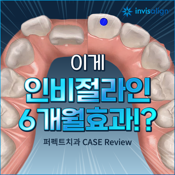 인비절라인 효과 알아보기 (+인비절라인라이트) 관련 이미지 1