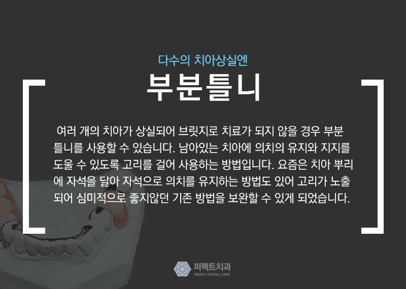 보철치료 종류와 비용 관련 이미지 6