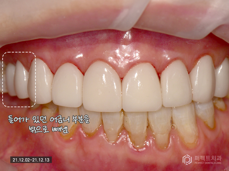 70대도 라미네이트가 가능하다구요? 관련 이미지 7