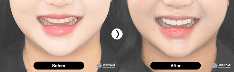 앞니 라미네이트 치아삭제량 확인해보세요! 관련 이미지 3