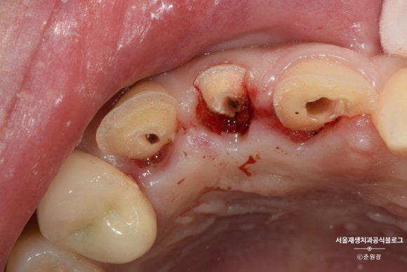 [치아외상] 부러진 앞니, 발치가 답인가요? (사고로 부러진 치아, 외과적정출술로 살리기) 관련 이미지 3