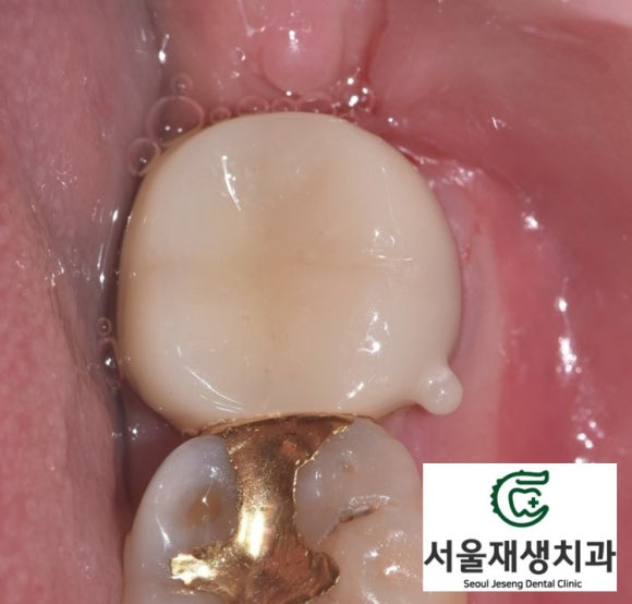 [재신경치료] 예전에 신경치료 받은 치아가 갑자기 너무 아파요! (서울재생치과, 현미경신경치료) 관련 이미지 9