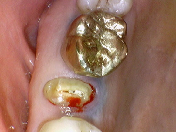 부러진 치아를 살려서 쓰는 법 (잇몸성형과 포스트식립) 관련 이미지 4