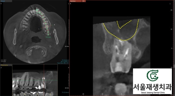 [재신경치료] 40대 남성, 윗 어금니 신경치료 후 상악동까지 염증이 전파된 사례 (서울재생치과 미세현미경치료) 관련 이미지 12