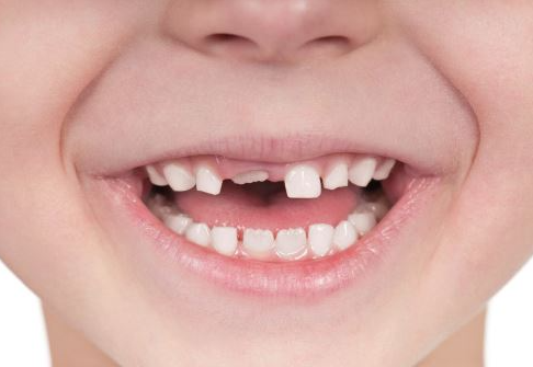 [재생근관치료] 이가 난지 얼마 안 됐는데 신경이 죽었대요...(소아 치아 외상, 치수 괴사, 미성숙 영구치, 신경재생술, REP, 치료기간, MTA 신경치료, 내원횟수) 관련 이미지 2