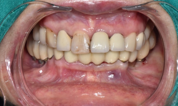 크라운 다음은 임플란트인가요...? (크라운 밑으로 생긴 충치, 크라운 다음엔 어떤 치료를...?, 자연치아 살리는 치과, 서울재생치과) 관련 이미지 9