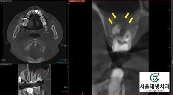 [재신경치료] 타치과에서 재신경치료 하는 중인데 발치를 하자고 했어요... (서울재생치과 현미경 신경치료) 관련 이미지 5