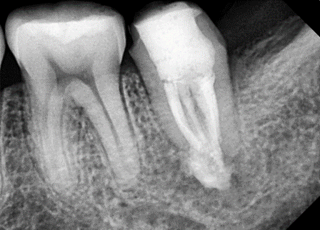 [신경치료] 아래 어금니를 신경치료 할 때 치료할 때 알아야 할 것 (C형근관,고난이도치료) 관련 이미지 12