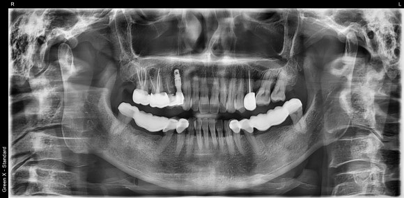 [임플란트] 좁은 공간에도 정밀하게, 1mm의 정교함을 잡은 임플란트 치료 관련 이미지 6