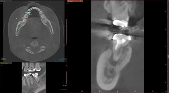 [재신경치료] 잇몸이 부었어요. 다니던 치과에서는 재신경치료 하거나 발치하라고 했어요. 관련 이미지 5
