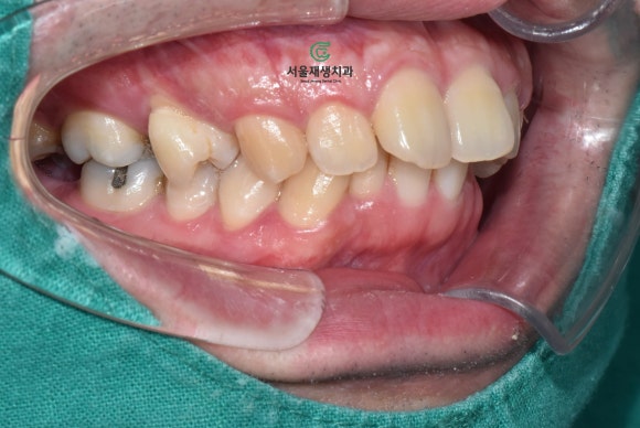 치과에서 치료하는 치아가 아닌 반대편 치아를 갈아내는 이유는? 장기 치료에 반드시 필요한 "정출방지 치아고정"에 대해 알아봅시다. 관련 이미지 8