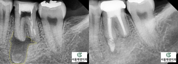 재신경치료의 치료 기간, 내원 횟수, 간격 (신촌치과, 서울재생치과, 서울대 보존과 전문의) 관련 이미지 9