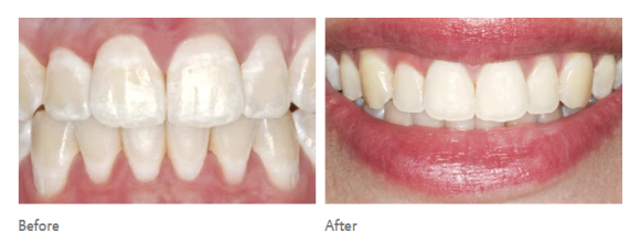 얼룩덜룩한 흰반점, white spot을 치료하는 법 (무삭제 충치치료) 관련 이미지 5