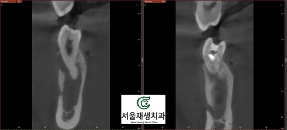 [치외치신경치료] 뿌리 끝 염증이 커서 발치해야된대요! 치아 머리에 볼~록! 알고보면 무서운 작은 혹 (서울재생치과) 관련 이미지 19