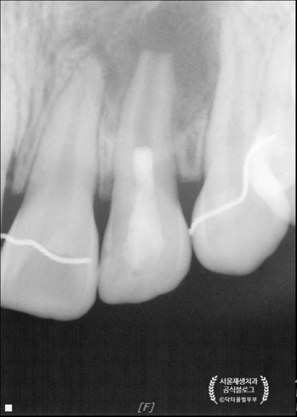 [재생근관치료] 이가 난지 얼마 안 됐는데 신경이 죽었대요...(소아 치아 외상, 치수 괴사, 미성숙 영구치, 신경재생술, REP, 치료기간, MTA 신경치료, 내원횟수) 관련 이미지 11