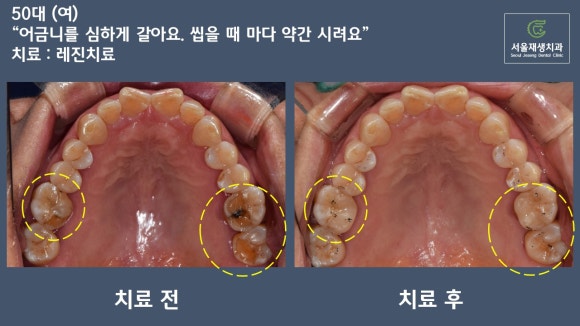 [치료사례] 어금니가 깨졌을 때 때워서 치료하는 방법 (어금니치료, 깨진 어금니, 치아파절, 치아마모) 관련 이미지 2