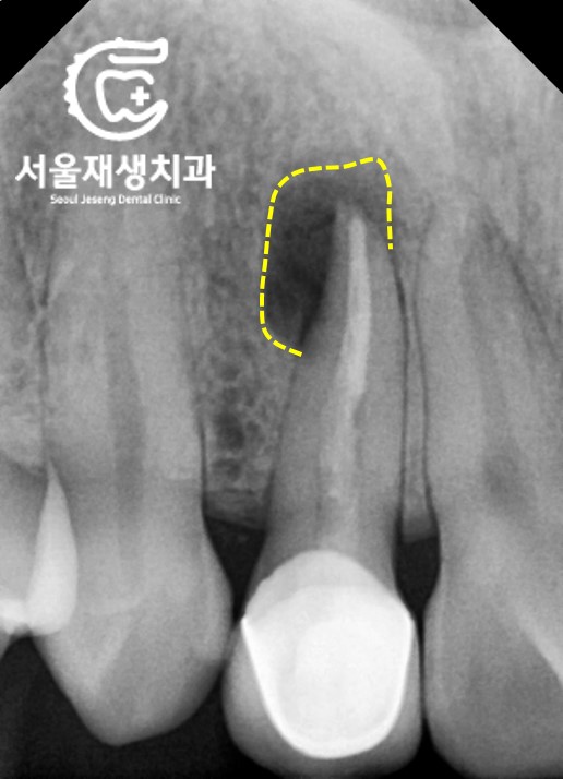 [재신경치료] 소중한 내 앞니...재신경치료로 다시 한 번 살려 쓸 수 있습니다. (서울재생치과, 현미경신경치료) 관련 이미지 5