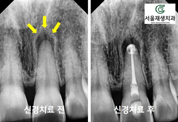 [치아미백] 예전에 다친 치아가 최근에 변색됐어요. 어떻게 해결하나요? (서울재생치과) 관련 이미지 7