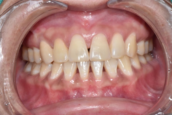 치아가 변색되면 무조건 크라운을 해야 하나요? (치아 미백, 실활치 미백, 신경치료 후 미백, 신촌치과추천,서울재생치과) 관련 이미지 12