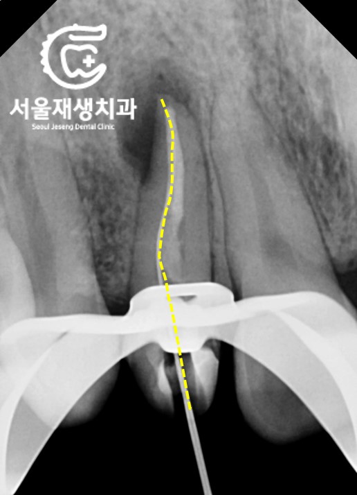 [재신경치료] 소중한 내 앞니...재신경치료로 다시 한 번 살려 쓸 수 있습니다. (서울재생치과, 현미경신경치료) 관련 이미지 6