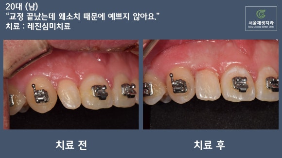 [치료사례] 왜소치/기형치를 크라운 없이 간단하게 치료하는 법 관련 이미지 1