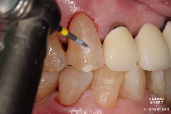 잇몸 패임, 무슨 재료로 때우나요? 레진과 글라스아이오노머(GI)로 치경부마모증 치료하기 (서울재생치과,신촌치과) 관련 이미지 18