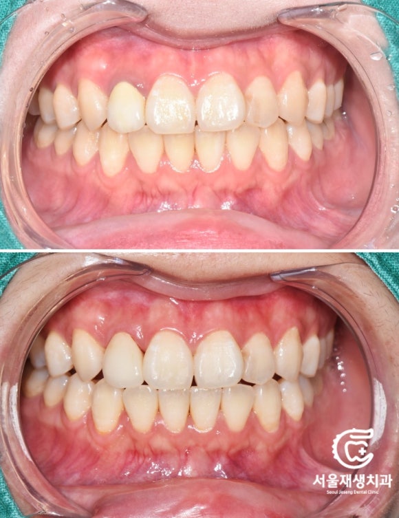 [재신경치료] 소중한 내 앞니...재신경치료로 다시 한 번 살려 쓸 수 있습니다. (서울재생치과, 현미경신경치료) 관련 이미지 14