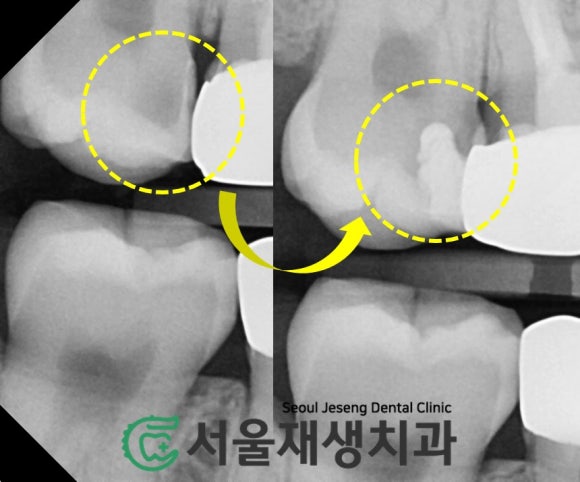 [MTA충치치료] 충치가 클 때.. 신경치료 안하고 치료하는 법 (치수복조술, 신촌 서울재생치과) 관련 이미지 15