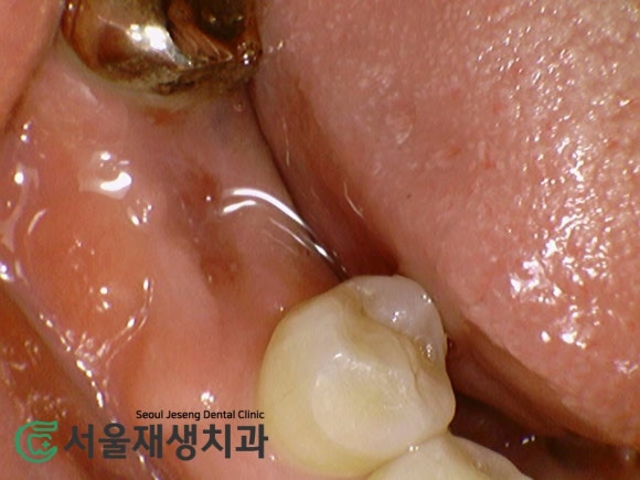 [발치 후 치유과정] 이를 뺀 후 아무는 과정, 단계별 주의사항 (신촌 서울재생치과) 관련 이미지 5