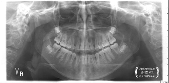 [재생근관치료] 이가 난지 얼마 안 됐는데 신경이 죽었대요...(소아 치아 외상, 치수 괴사, 미성숙 영구치, 신경재생술, REP, 치료기간, MTA 신경치료, 내원횟수) 관련 이미지 5