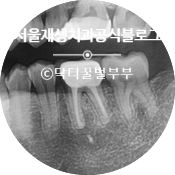 [재신경치료] 신경치료 받은 치아인데 잇몸에 뾰루지가 올라왔어요. (신촌 재신경치료 맛집, 신촌 서울대 보존과 전문의, 치근단 염증) 관련 이미지 19