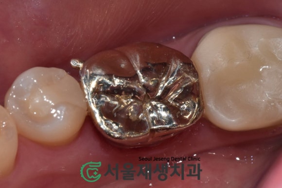 [재신경치료] 예전에 신경치료 받은 치아....치근단 절제술이나 발치를 해야 한다는데요?! (신촌 서울재생치과) 관련 이미지 14