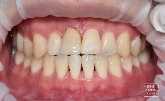넘어져서 이가 여러군데 깨졌어요ㅠ (치아외상토탈케어, 서울재생치과, 치아 부러짐, 치아 파절) 관련 이미지 6