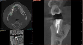 [재신경치료] 6개월 전에 신경치료한 치아에서 고름이 나와요. 관련 이미지 10