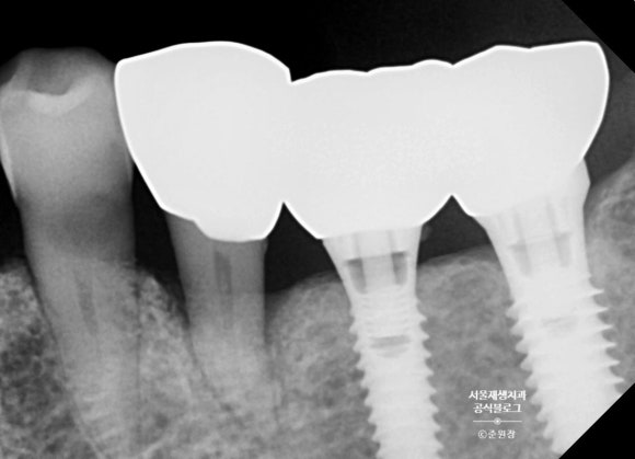 [턱관절] 임플란트 맞은 편 치아가 아파요! (외상성교합, 강한 교합력, 보톡스 치료,턱관절물리치료, 치과 보험진료) 관련 이미지 4